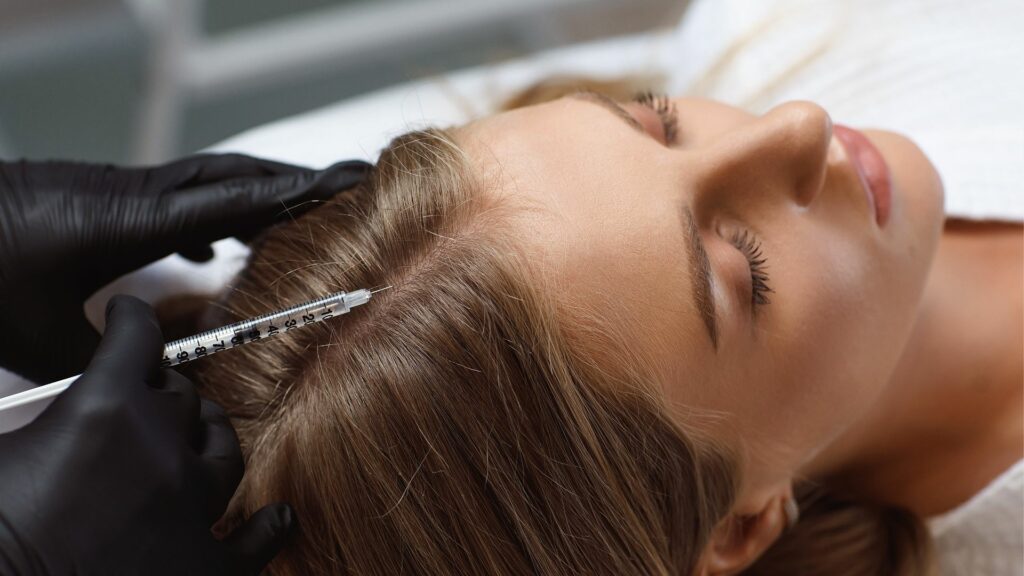 Perte des cheveux : les bienfaits de la mésothérapie capillaire