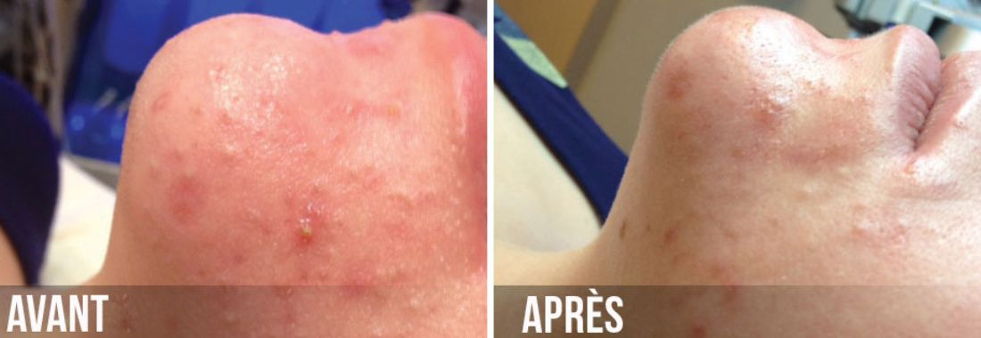 avant-apres-hydrafacial-acne-clinique-clemenceau