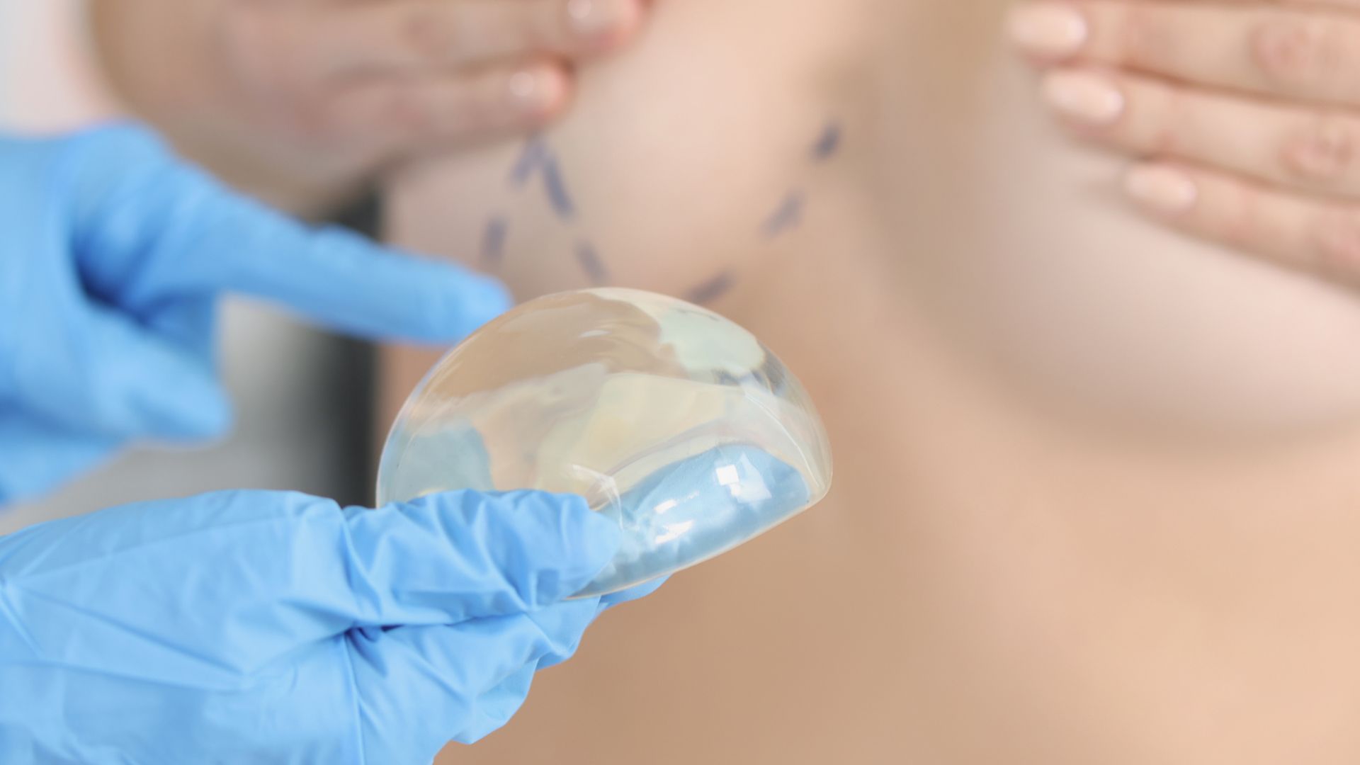Pose d'implants mammaires : le guide à la Clinique Clemenceau