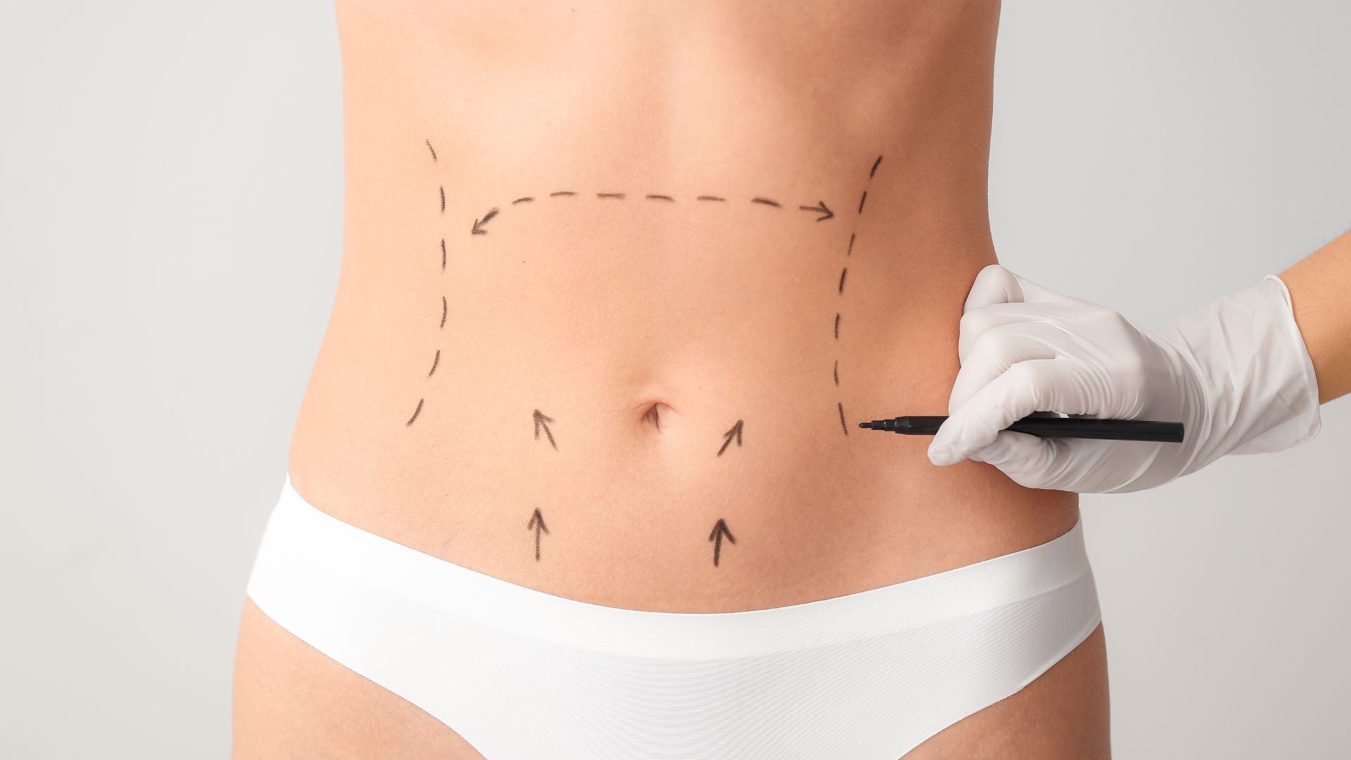 Abdominoplastie ou Lipoaspiration à la Clinique Clemenceau Arras